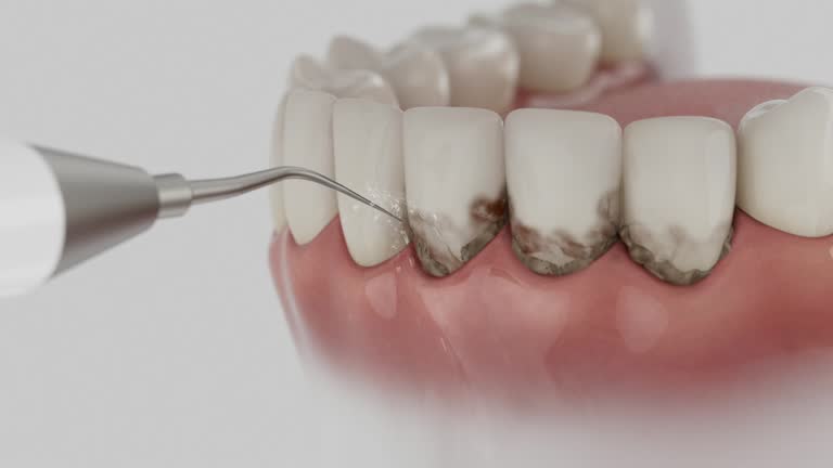 Trusted Wisdom Tooth Removal service in Hudson, CO - Dentist Open Now
